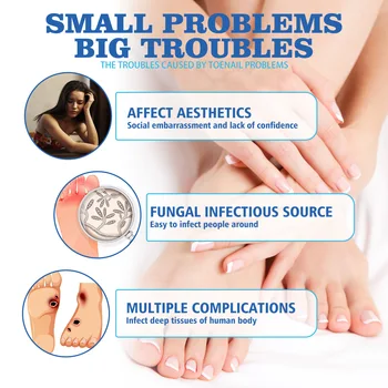 Мехлем за лечение на гъбички на ноктите Средство за премахване на особено силен ефективен крем Възстановително средство срещу краката е най-Доброто средство срещу